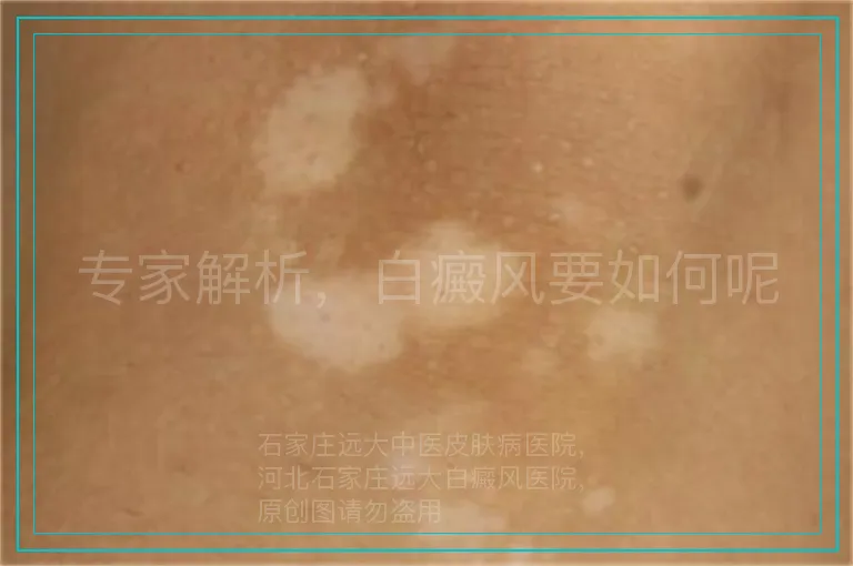 专家解析,白癜风要如何呢