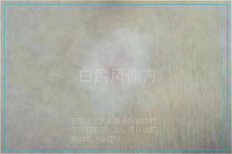 白癜风偏方