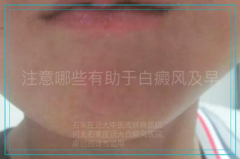 注意哪些有助于白癜风及早