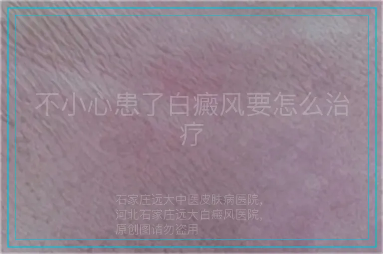 不小心患了白癜风要怎么治疗