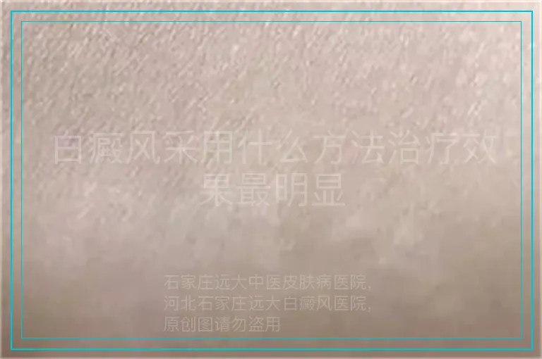 白癜风采用什么方法治疗效果最明显