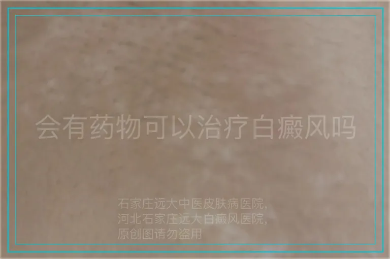 会有药物可以治疗白癜风吗