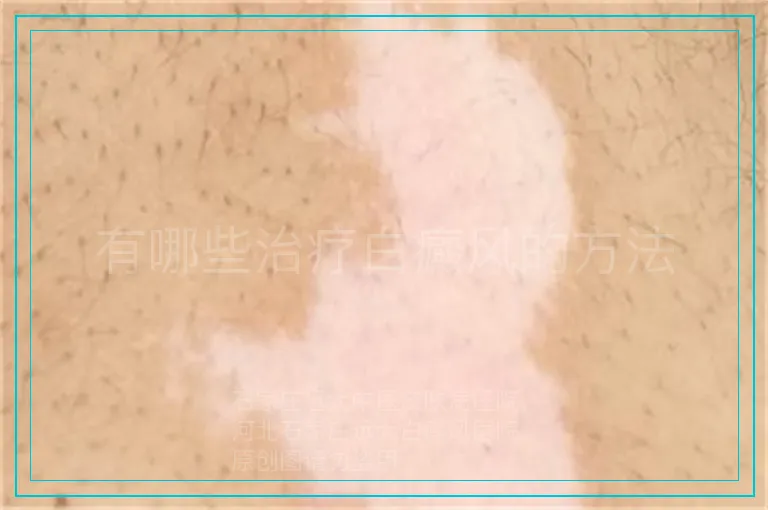 有哪些治疗白癜风的方法