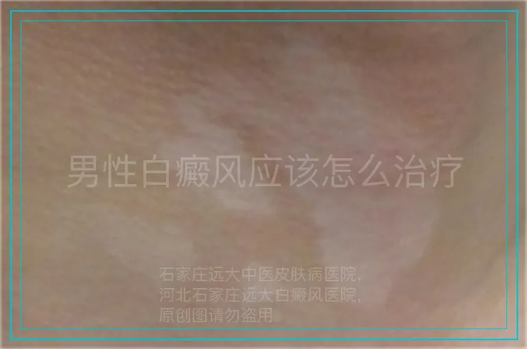 男性白癜风应该怎么治疗