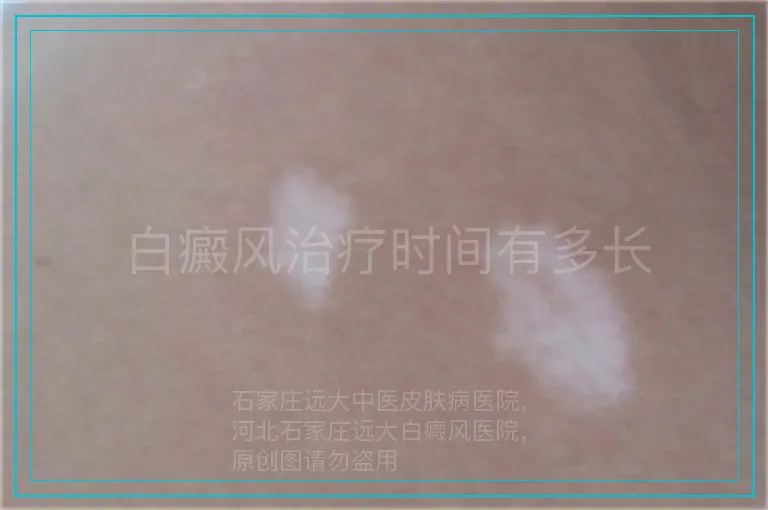 白癜风治疗时间有多长