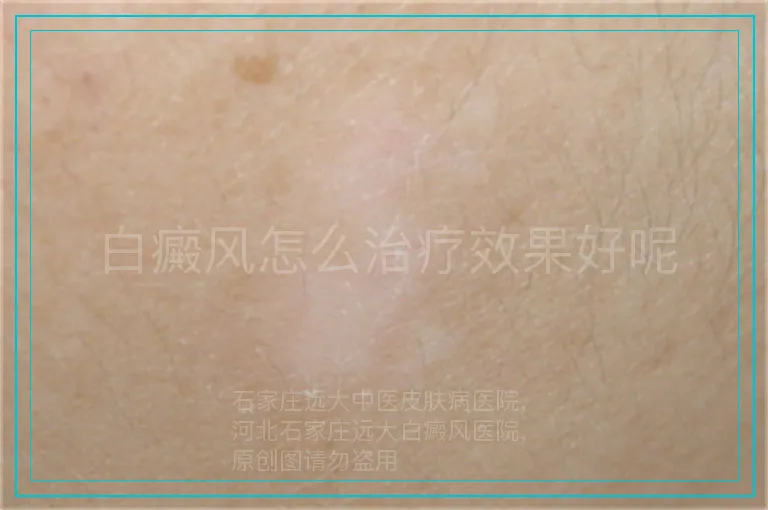 白癜风怎么治疗效果好呢