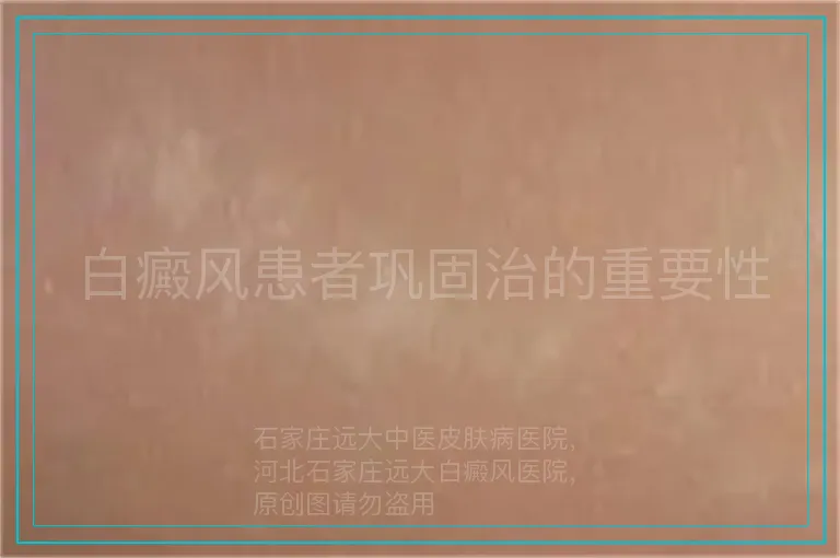白癜风患者巩固治的重要性