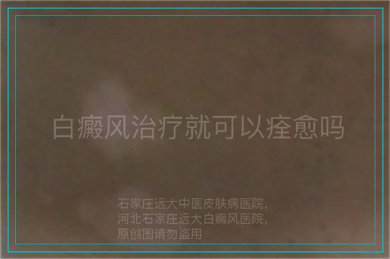 白癜风治疗就可以痊愈吗