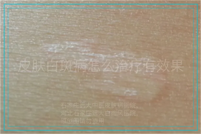 皮肤白斑病怎么治疗有效果
