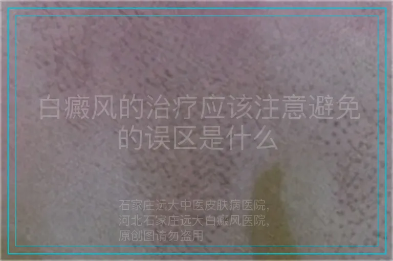 白癜风的治疗应该注意避免的误区是什么