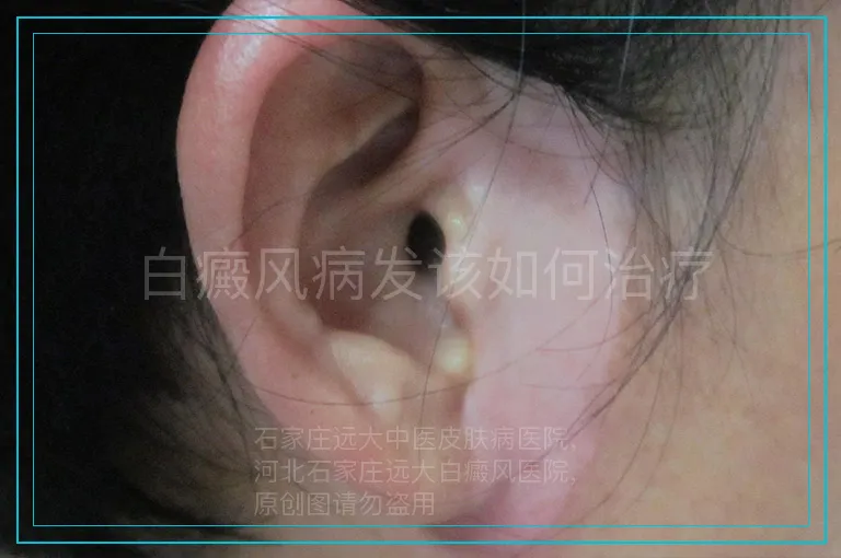 白癜风病发该如何治疗