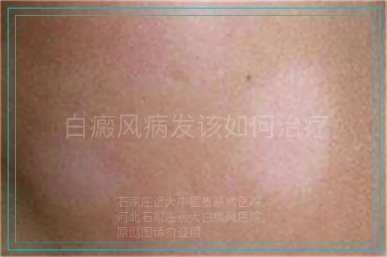 白癜风病发该如何治疗