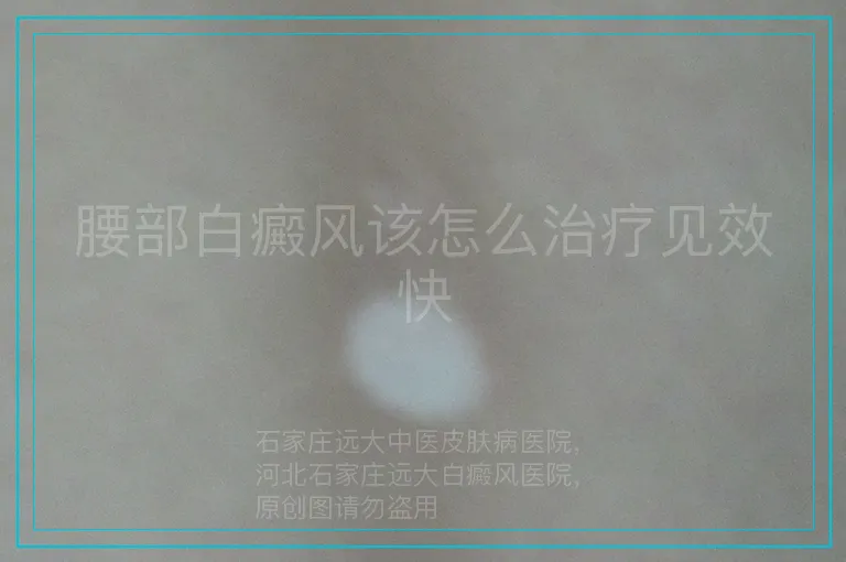 腰部白癜风该怎么治疗见效快