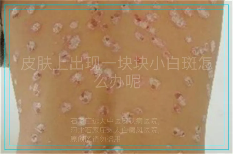 皮肤上出现一块块小白斑怎么办呢