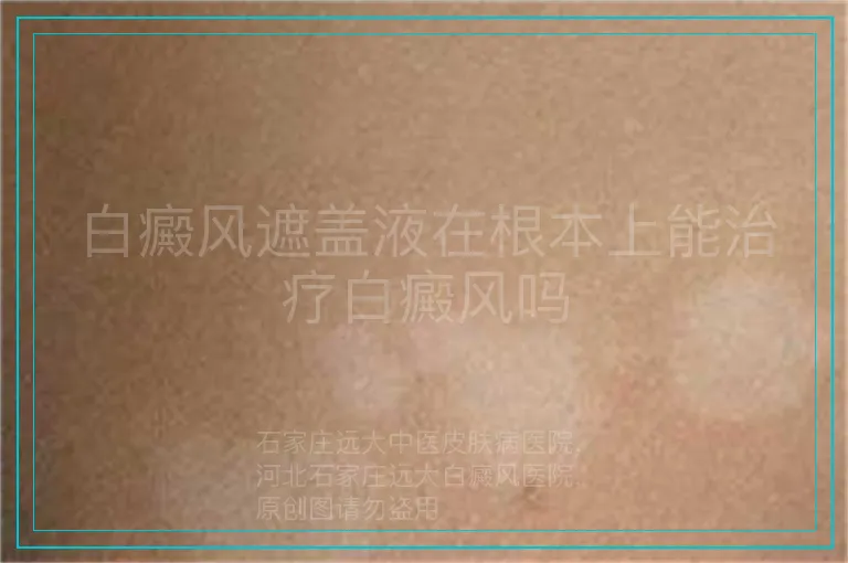 白癜风遮盖液在根本上能治疗白癜风吗