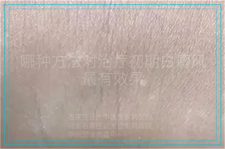 哪种方法对治疗初期白癜风最有效果