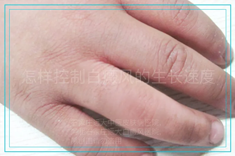 怎样控制白癜风的生长速度