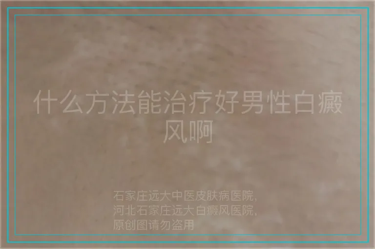 什么方法能治疗好男性白癜风啊