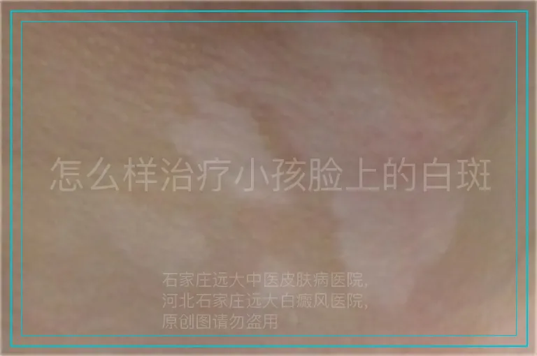 怎么样治疗小孩脸上的白斑