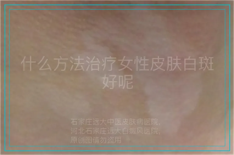 什么方法治疗女性皮肤白斑好呢