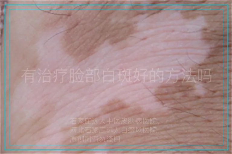 有治疗脸部白斑好的方法吗
