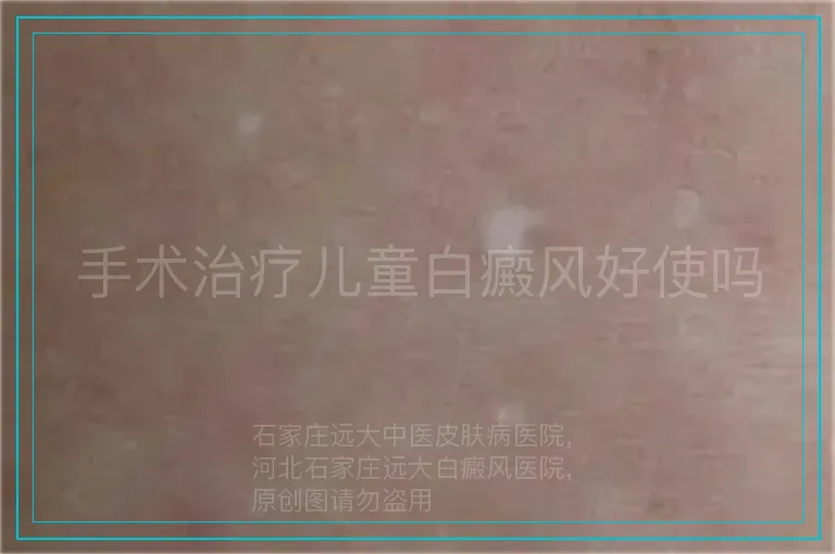 手术治疗儿童白癜风好使吗
