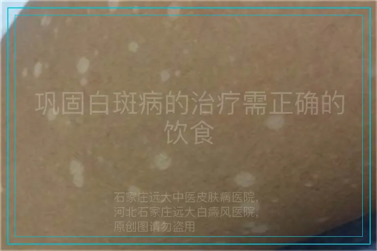 巩固白斑病的治疗需正确的饮食