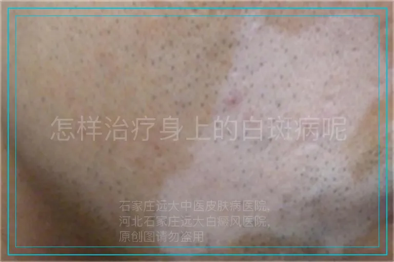 怎样治疗身上的白斑病呢