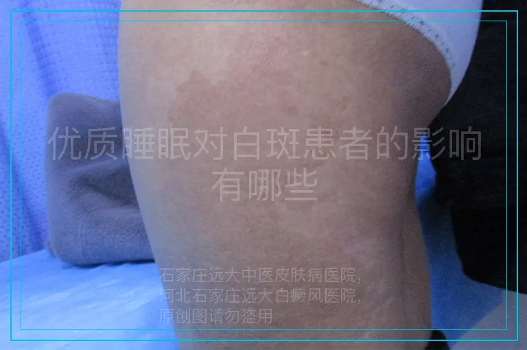 优质睡眠对白斑患者的影响有哪些