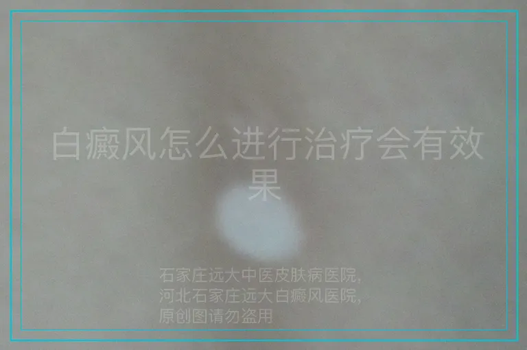 白癜风怎么进行治疗会有效果