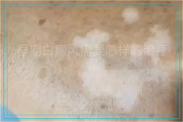 早期白癜风需要怎样的治疗呢