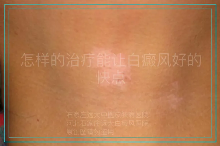 怎样的治疗能让白癜风好的快点