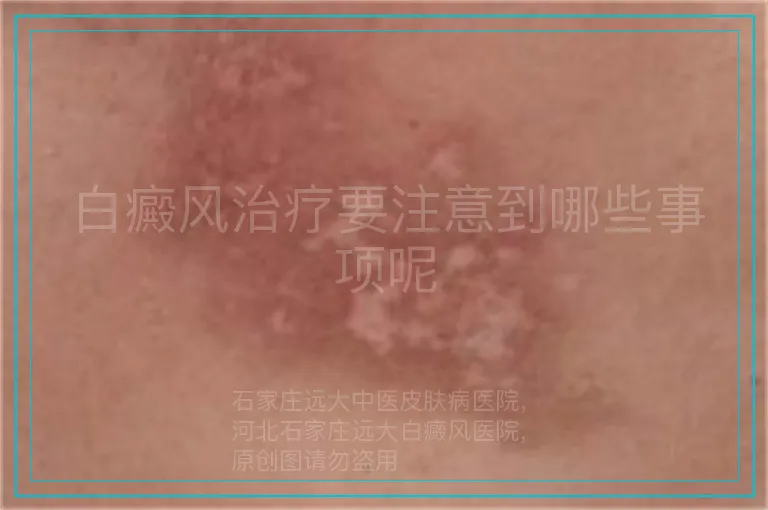 白癜风治疗要注意到哪些事项呢