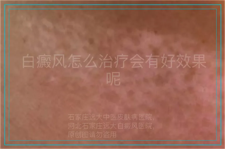 白癜风怎么治疗会有好效果呢