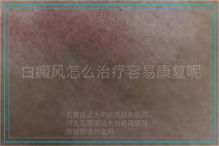 白癜风怎么治疗容易康复呢