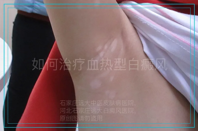 如何治疗血热型白癜风