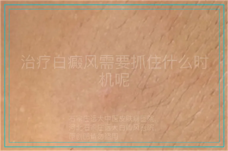 治疗白癜风需要抓住什么时机呢