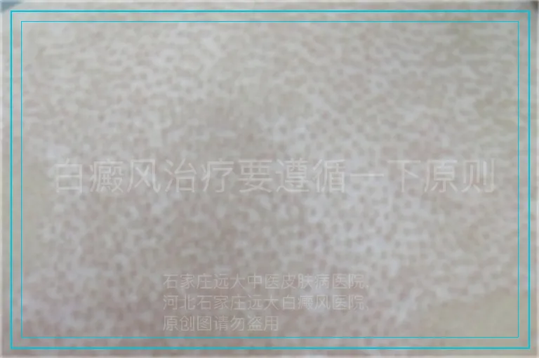 白癜风治疗要遵循一下原则