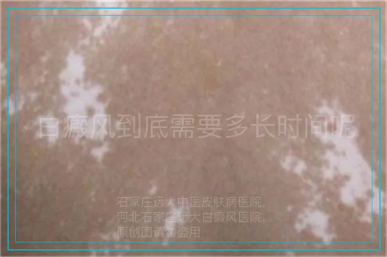 白癜风到底需要多长时间呢