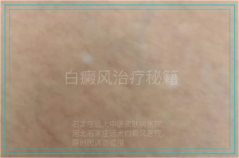 白癜风治疗秘籍