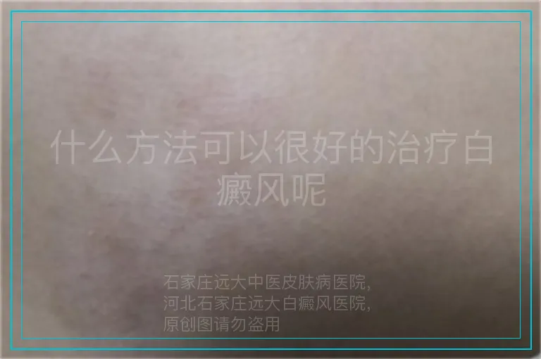 什么方法可以很好的治疗白癜风呢