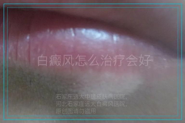 白癜风怎么治疗会好
