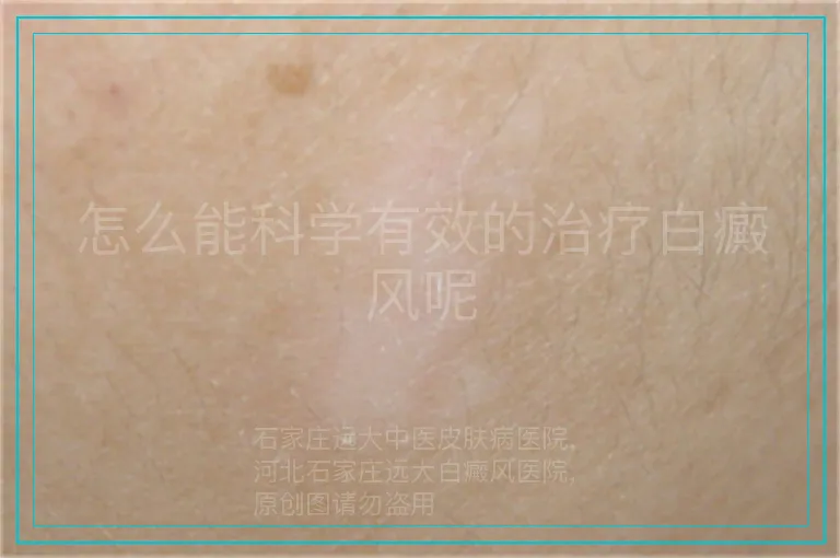 怎么能科学有效的治疗白癜风呢