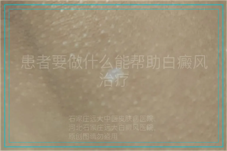 患者要做什么能帮助白癜风治疗