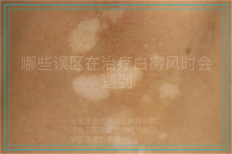 哪些误区在治疗白癜风时会遇到