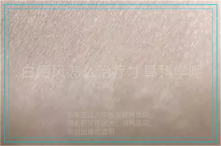 白癜风怎么治疗才算科学呢