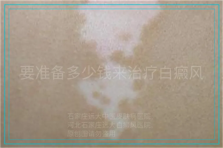 要准备多少钱来治疗白癜风