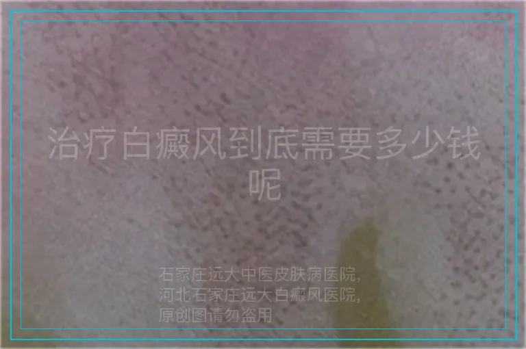 治疗白癜风到底需要多少钱呢
