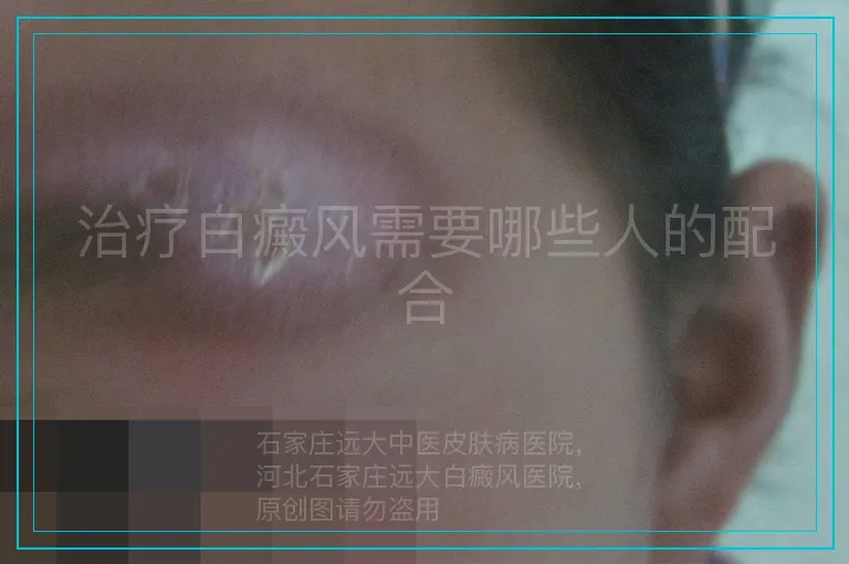 治疗白癜风需要哪些人的配合