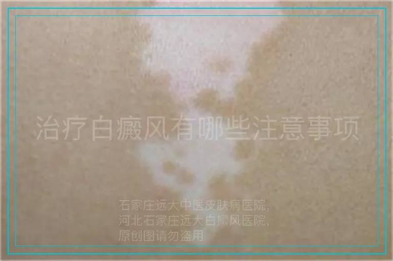 治疗白癜风有哪些注意事项